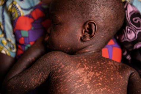 Measles: In the shadow of COVID-19 | MSF UK