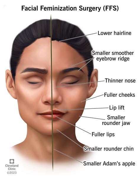 Facial Feminization Surgery (FFS): Procedure & Recovery