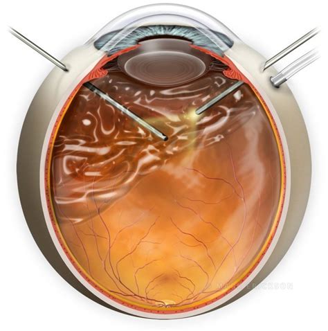 Pars plana vitrectomy PPV vitreoretinal eye surgery illustration