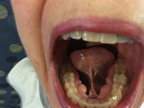 A Case of Oral Tori in a 60-Year-Old Woman | Consultant360