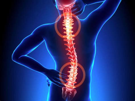 Spondylosis: 10 Spondylosis Symptoms