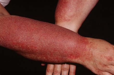 Dermatomyositis - Causes, Rash, Symptoms, Diagnosis & Treatment