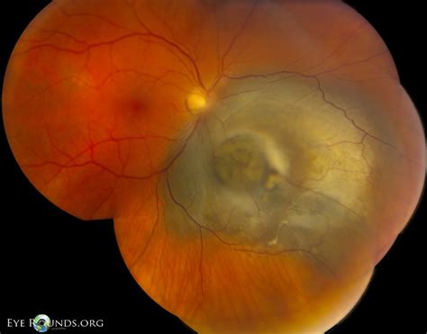 Atlas Entry - Choroidal malignant melanoma in a "collar button ...