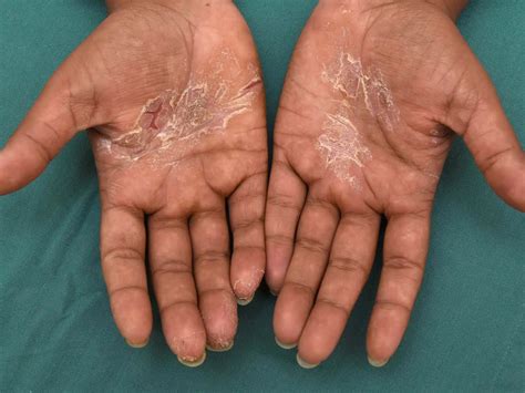 Atopic Dermatitis Hands Treatment