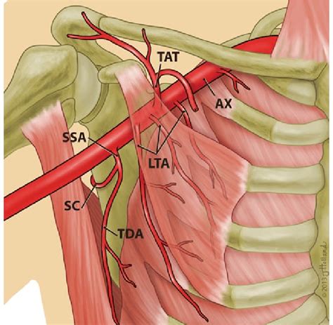 type V-multiple lateral thoracic arteries (LTA) are present (3.2 % ...