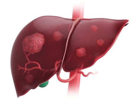 Hepatocellular Carcinoma (HCC) Treatment Approach