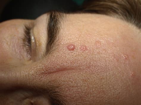 Hydrogen peroxide 40% safe for facial seborrheic keratoses