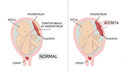 Placenta Accreta: Symptoms, Causes, Risk Factors, Diagnosis, Treatment ...