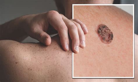 Skin cancer symptoms: What does skin cancer look like? 10 signs to get ...