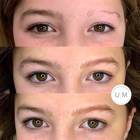 Childhood Alopecia and Eyebrow Restoration — Utah Microblading