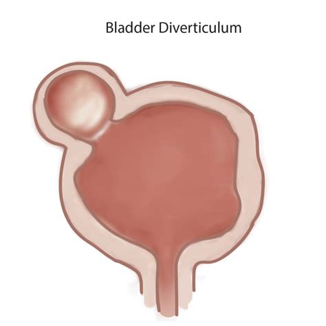 [Figure, Illustration of a bladder diverticulum. Contributed by Rian ...