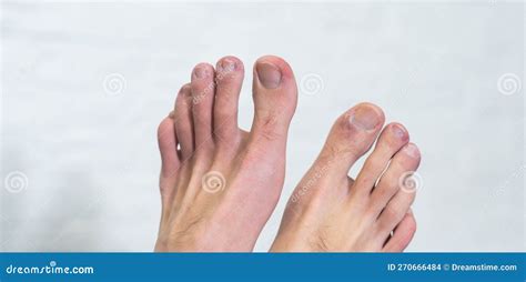 A Man S Toes Showing What Looks Like a Rash with Red Blotchy Skin. a ...