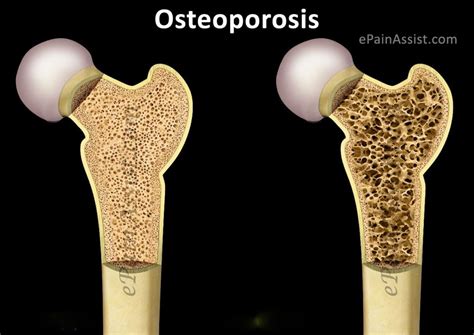 OSTEOPOROSIS - Cuidado adulto mayor Mexico DF, servicios enfermeria