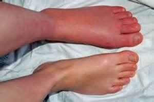 Researchers Continue To Look for Basic Understanding of CRPS Causes