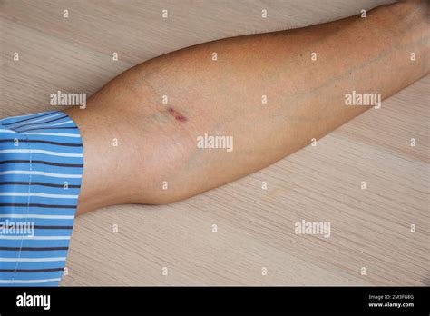 Bruise or ecchymosis of Asian man arm from needle after blood drawn for ...