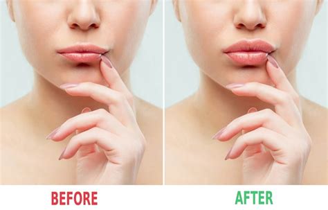 What To Expect After Botox Lip Flip | Sitelip.org