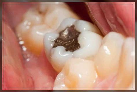 Gold Fillings: Pros and Cons - Engiomed