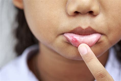 What is the best way to treat mouth ulcers in children?