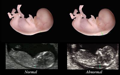 alo's place: Nuchal Translucency Test