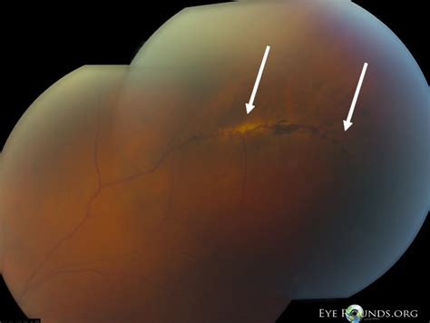 Atlas Entry - Peri-Vascular Lattice Degeneration