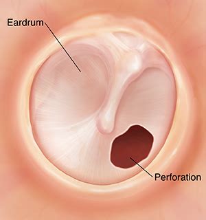 Perforated Eardrum - Symptoms, Causes, Treatment, Antibiotics