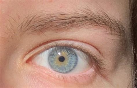 Central Heterochromia Iridis