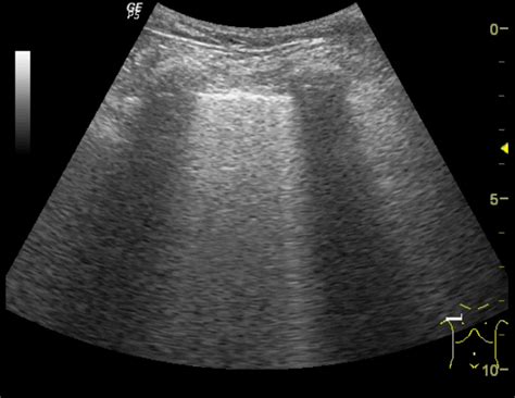 B lines - how best to see them - Critical Care Sonography