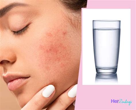 Does Drinking Water Truly Help Control Acne? Expert Explains | HerZindagi