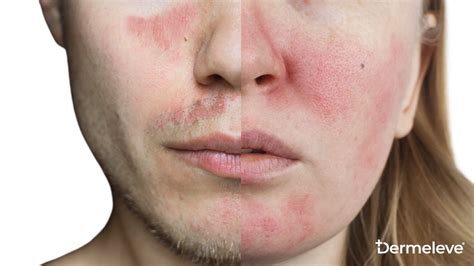 Lupus Rash vs. Rosacea: Understanding Malar & Butterfly Rashes – Dermeleve®