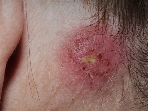 Staph infection: Types, symptoms, causes, treatments - Medical News Today