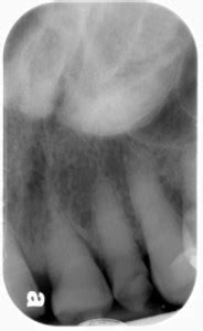 Palatal Tori – Dr. G's Toothpix