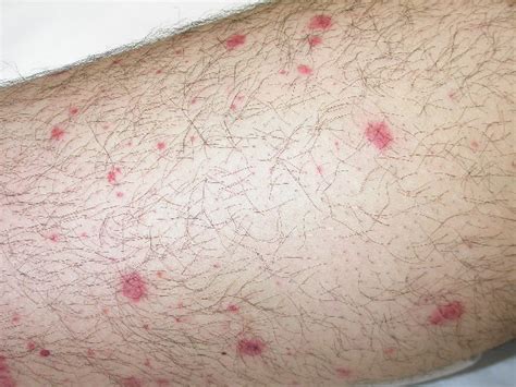 Red Spots On Skin Petechiae | Images and Photos finder