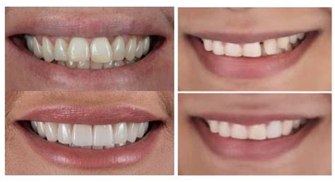 Transform Your Teeth with Clear Aligners: Before and After Pictures