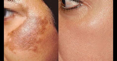 Skin Discoloration On The Cheeks: Causes And Treatment | Heidi Salon