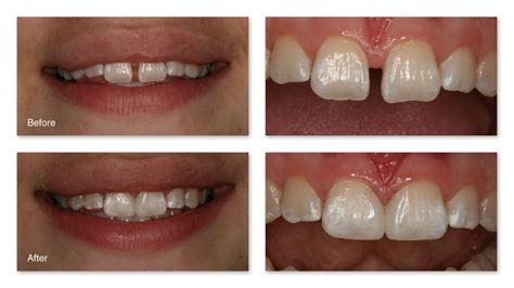 Braces Before And After Gap