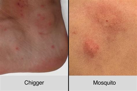 Chigger Bites Vs. Mosquito Bites: How to Tell the Difference | The Healthy