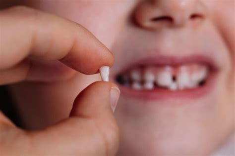 What to do when your child has loose teeth - Willows Dentistry