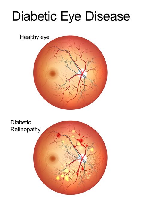 Diabetic Retinopathy Stages