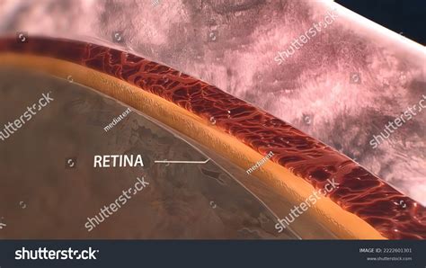 Uveitis Inflammation Part All Uvea Eye Stock Illustration 2222601301 ...