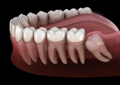 Impacted Wisdom Teeth - Flowood, MS: Oral & Facial Surgery of Mississippi