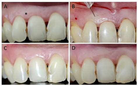 Interdental Gingiva