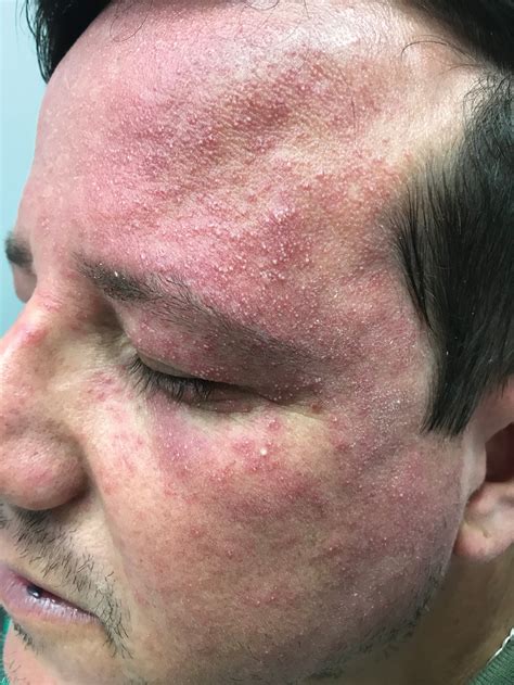 Pruritic and Pustular Eruption on the Face | MDedge Dermatology