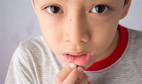 Mouth Ulcer in Kids: How To Treat Mouth Ulcer In Children?