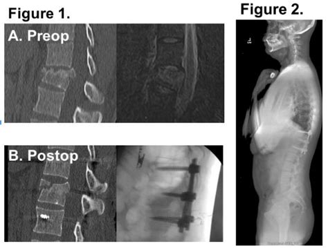 T12 Burst Fracture – Smiss