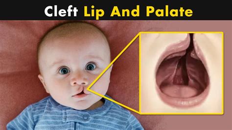 What Causes Cleft Lip And Cleft Palate? | Symptoms, Causes And ...