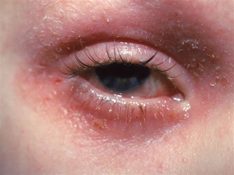 Eyelid Dermatitis (Eczema): Symptoms, Causes, And Treatment, 59% OFF