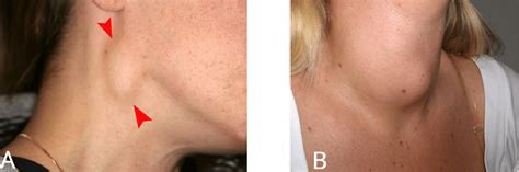 Neck Lumps - Differential Diagnosis - Investigation - TeachMeSurgery