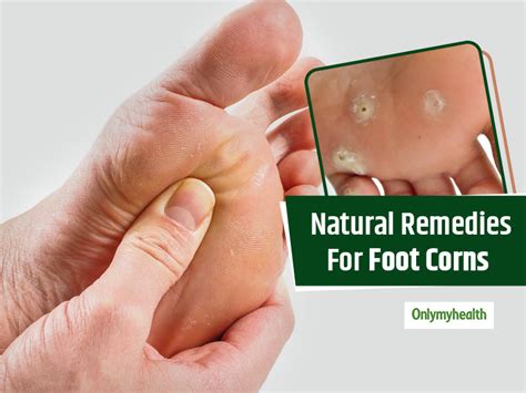 Foot Corn: Symptoms, Causes, Treatment, Medicine, Prevention, Diagnosis ...