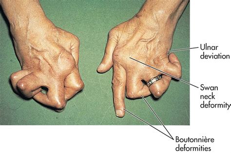 What Causes Foot Deformities - Design Talk