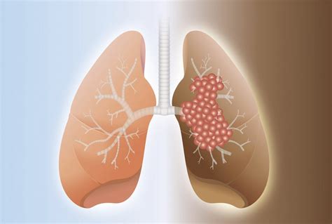 Pulmonary Fibrosis - Lung Care Foundation